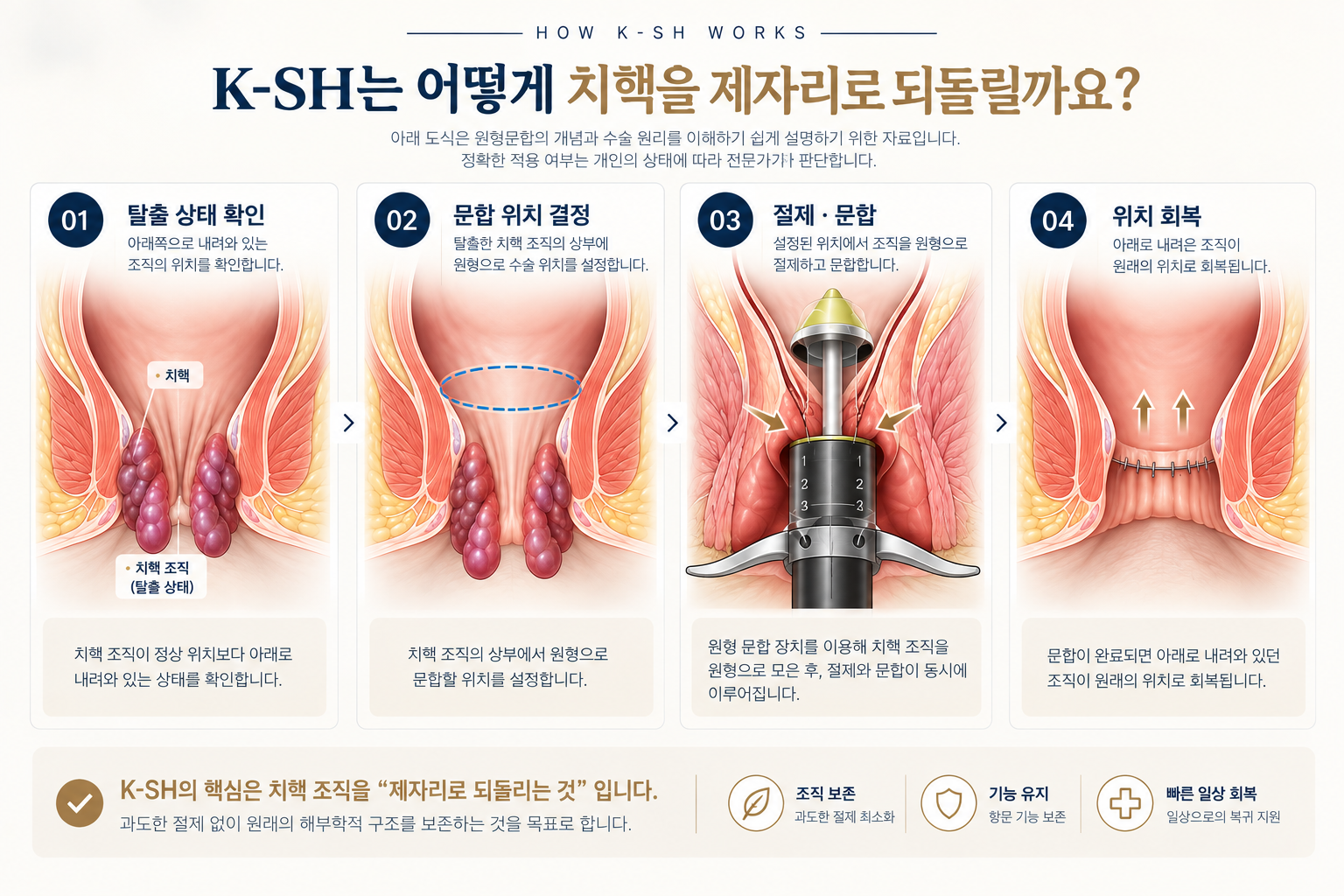 K-SH 수술 원리 전체 4단계: 탈출 상태 확인, 문합 위치 결정, 조직 절제와 원형 문합, 탈출 조직의 위치 회복